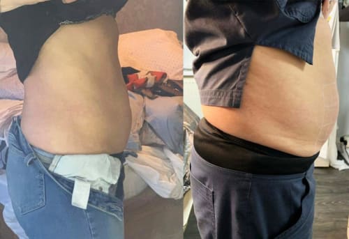 Fat freezing cryo-lipolysis before and after