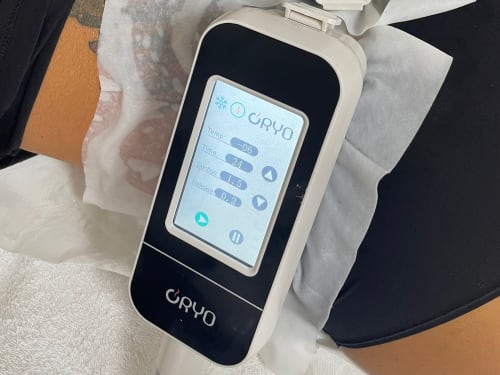 Close-up of our cryolipolysis machine freezing fat on a client's waist. The machine head display is visible, showing that fat cells in the targeted area are being chilled to a little below freezing temperature.