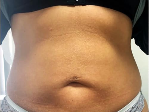 Client before starting fat freezing treatment