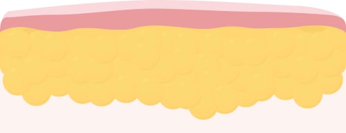 Illustration of a large quantity of subcutaneous fat cells creating lumps and bumps on the skin