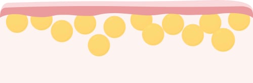 Illustration showing the previously large quantity of fat cells significantly reduced in number and a much flatter, smoother layer of skin above them
