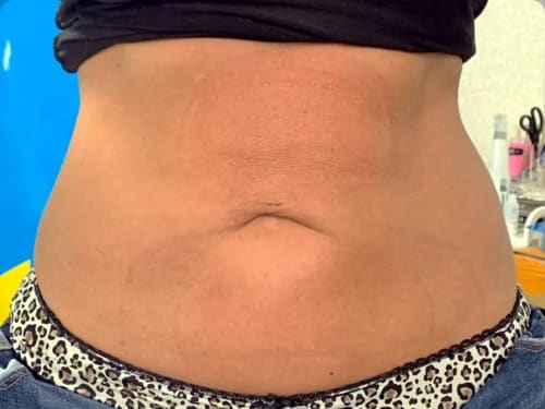 Client after second fat freezing session as part of an 8 week treatment plan