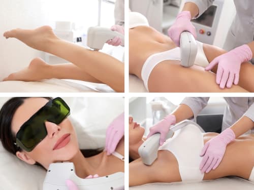 Client undergoing a variety of laser hair removal treatment