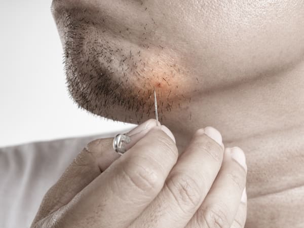 A min picks at an ingrown hair on his chin caused by shaving