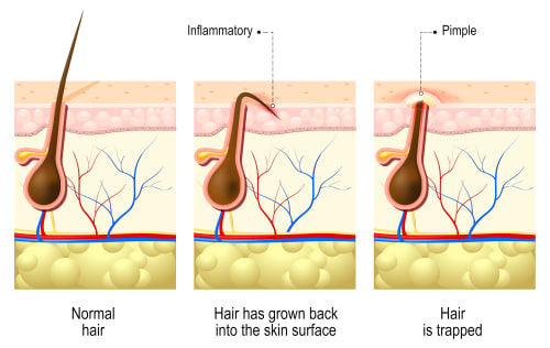 Side section of skin illustrating ingrown hair types versus healthy hair