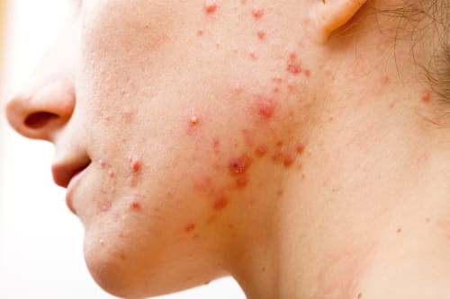 Acne condition on the side of a young woman's face