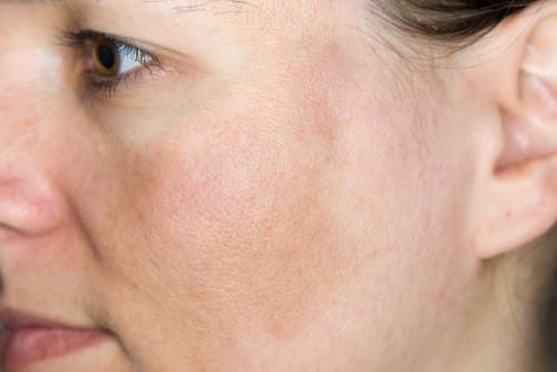 A close-up of the side of a young woman's face showing a patch of dark pigmentation in the skin.