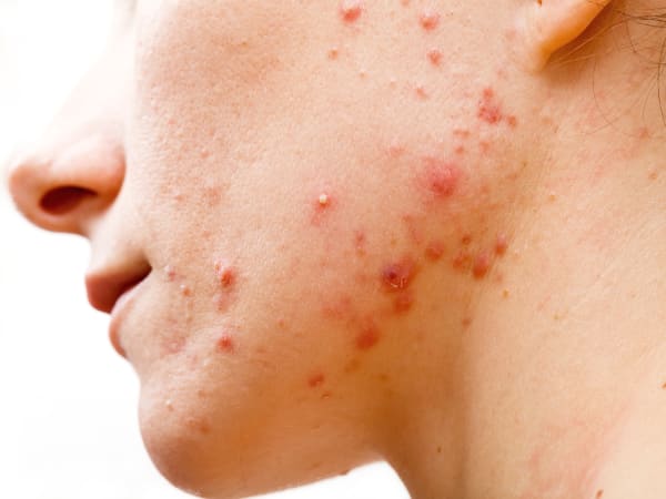 Close-up of an acne breakout on the side of a young woman's face, particularly around the jaw line