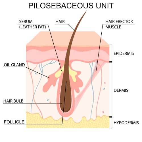 Illustration of normal pilosebaceous unit: cross section through skin highlighting sebaceous gland, sebum and hair follicle