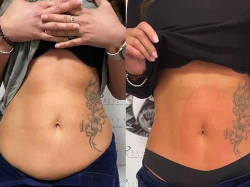 HIEMT treatment: before and after results showing remarkable belly fat reduction