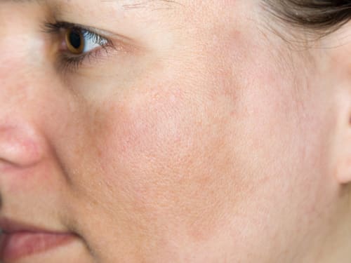Understanding Hyperpigmentation: Causes and Treatments