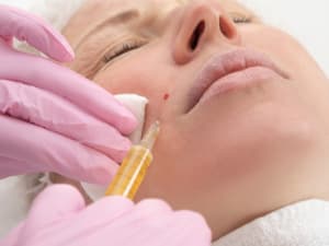An aesthetician injecting platelet rich plasma into a client's skin around their mouth.