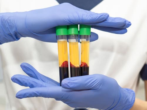 A nurse holds three vials of blood separated into concentrated platelet-rich plasma