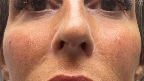 Client after dermal face filler