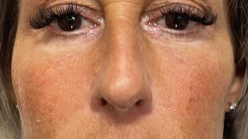 Client before dermal face filler