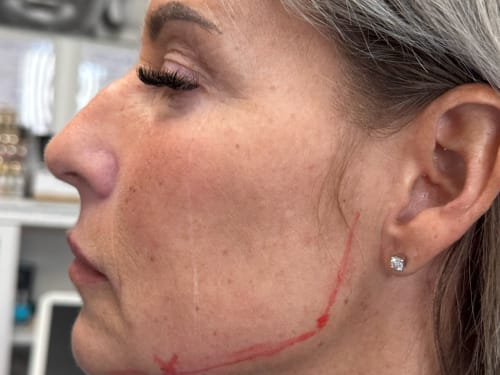 Client before dermal fillers - left side of face