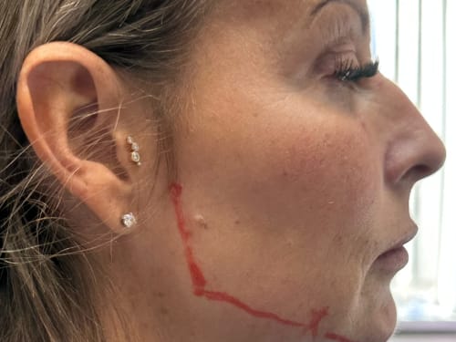 Client before dermal filler - right side of face