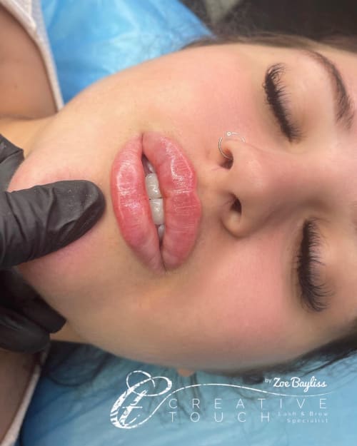 Client after Russian lip filler treatment