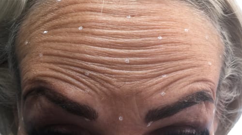 Example of forehead wrinkles on a client before treatment