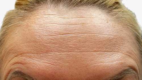 Significant smoothing of forehead lines following anti-wrinkle treatment
