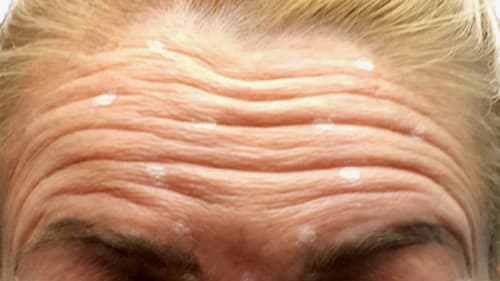 Example of deep forehead lines on a client before treatment