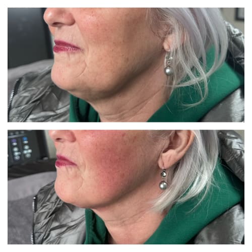 The rejuvenating effect of PE Face - before and after