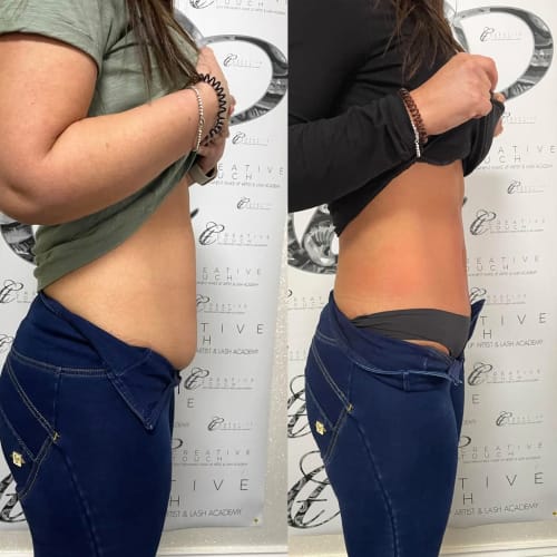 Side profile view of our client's abdomen showing a substantial reduction in subcutaneous fat and improved abdominal muscle strength