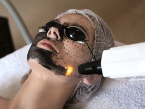 A woman part way through a Laser Carbon Peel facial. The carbon cream has been removed on one side of her face with a laser, burning off skin impurities in the process.