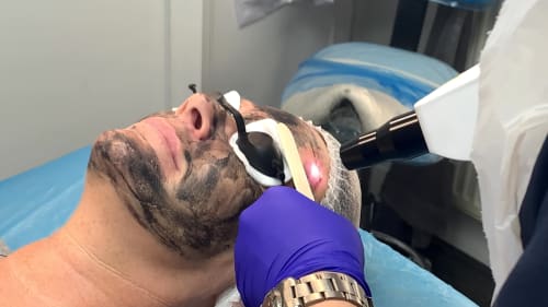 A client receiving a laser carbon facial treatment. The laser can be seen removing the carbon layer after it has absorbed impurities from the skin.