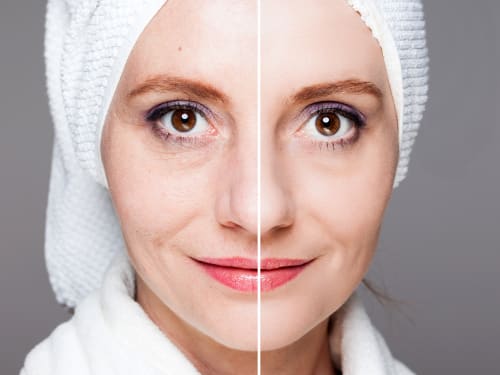 Before and after skin rejuvenation – split portrait of a middle-aged woman