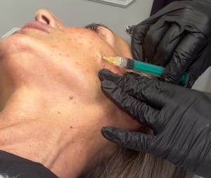 Mesotherapy & Skin Boosters in Rotherham