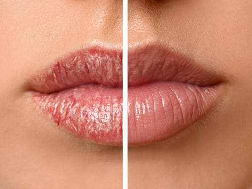 A close-up before and after split of a woman's dry, cracked lips versus plump hydrated lips