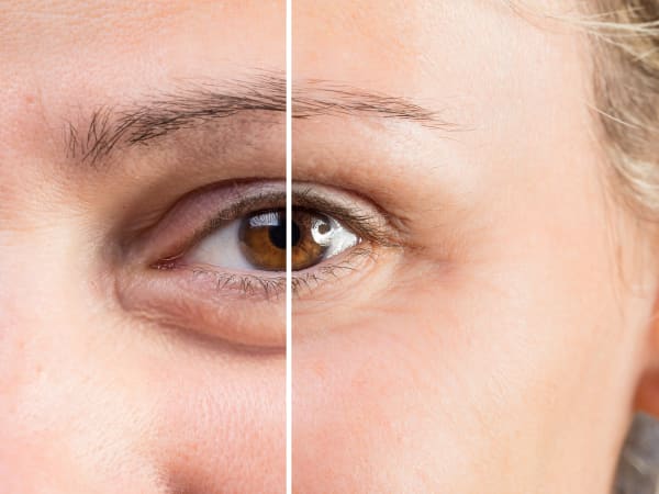 Close-up split image showing before and after skin booster rejuvenation under the eyes to remove dark circles, puffiness and fine wrinkles