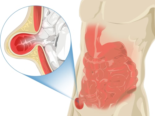 Illustration of a hernia showing part of the intenstines poking through the abdominal wall.