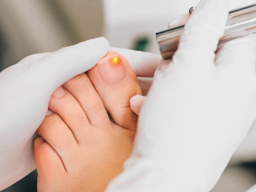 Close-up of laser treatment for toenail fungus