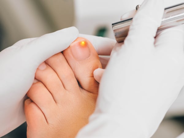 Closeup of a client receiving medical laser treatment on a toenail for fungal infection.