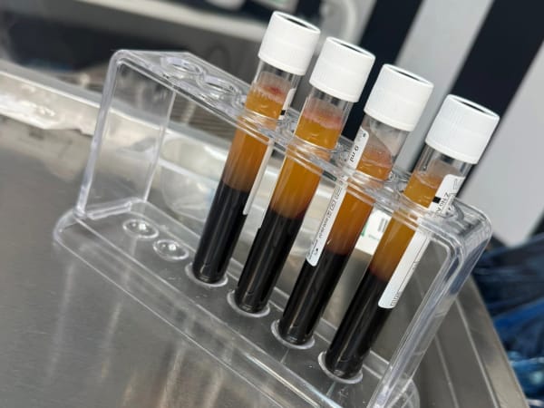 Vials of separated blood plasma extracted from patient and placed through a centrifuge at low speed. This plasma and fibrin mix forms the basis of iPRF treatment.