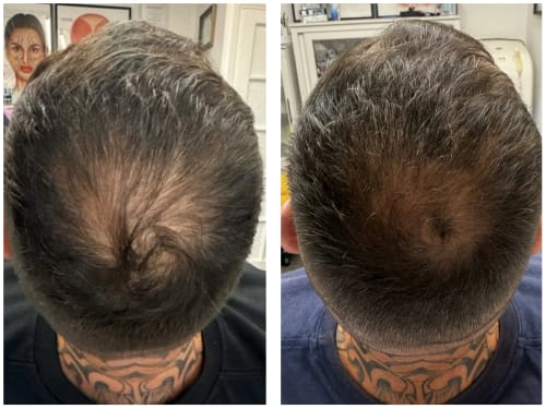 iPRF hair restoration before and after results showing increased density and coverage