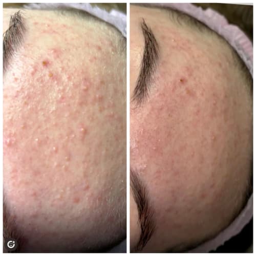 Before and after acne treatment: side by side comparison showing marked reduction in acne breakout on the forehead