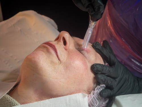 Cold Plasma Blepharoplasty: a Creative Touch client being treated with cold plasma to lift her upper eyelids
