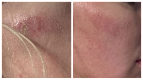 Before and after cold plasma: side by side showing a large area of friction burned skin treated with cold plasma, with rapid healing to the area after