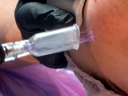 Close up of Cold Atmospheric Plasma in action, showing fine blue/purple threads of plasma stretching out from the tool tip to the client's skin