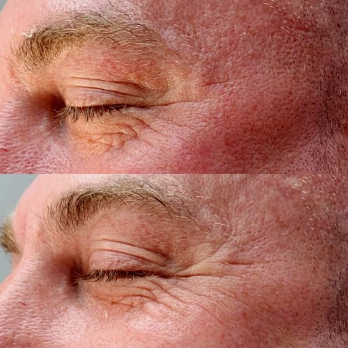 Bioneedling Reliftalia treatment before and after