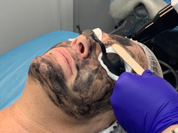 Client with a carbon facial, mid-treatment