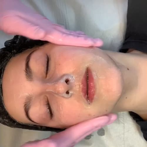 Close-up of a client receiving a Comcit facial treatment, showing the application of the freezing solution and the visible effects on the skin.