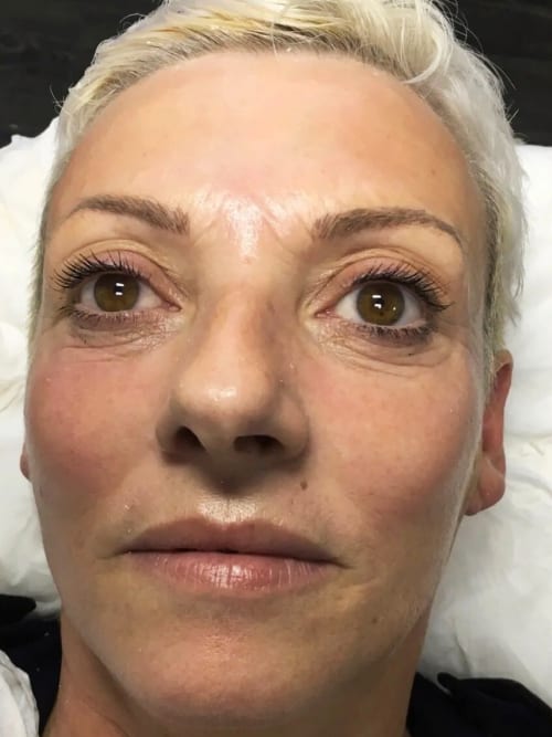 After Oxygen Therapy treatment