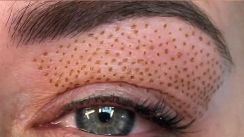 After plasma pen treatment