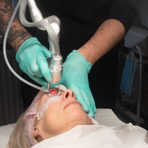 Thulium laser being used around the delicate eye area