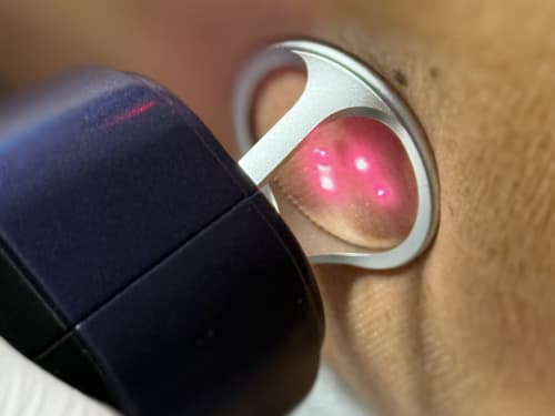 Extreme close-up of the Thulium 1926nm fractional laser handpiece creating precise, controlled micro-treatment zones on the skin surface.