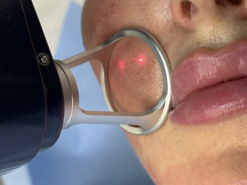 Thulium fractional laser treatment in progress on a client's cheek at Creative Touch in Rotherham, showing the precise laser handpiece and red target dots.
